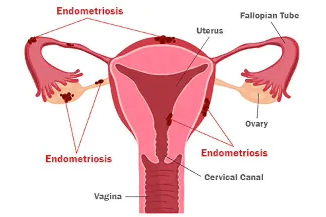 Birth control pills may help women who suffer from endometriosis. 