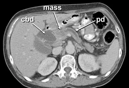 An abdominal CT scan shows a small, vaguely seen 2-cm pancreatic adenocarcinoma (mass) causing obstruction of both the common bile duct (cbd) and pancreatic duct (pd).