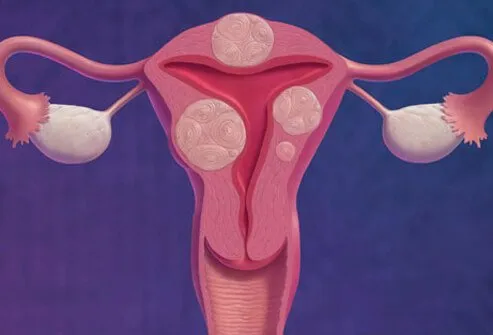 Illustration of uterine fibroids.