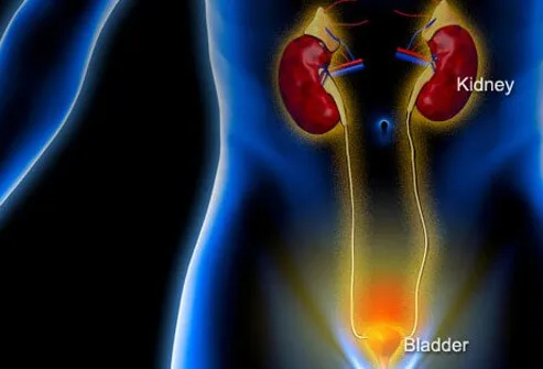 Illustration of urinary tract infection (UTI).