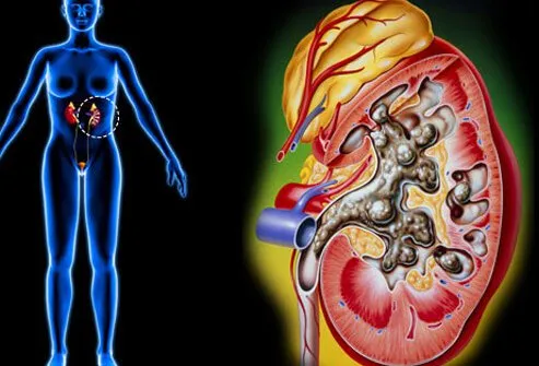 Illustration of kidney stones.