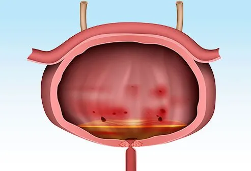 Kidney stones are composed of crystals that usually form in the kidneys or ureters.