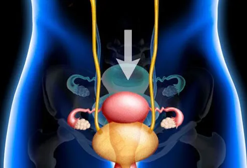 Pelvic prolapse is a condition where a pelvic organ such as the bladder or uterus drops into a lower than normal position.