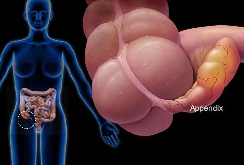 An infected appendix needs to be removed by a surgeon.