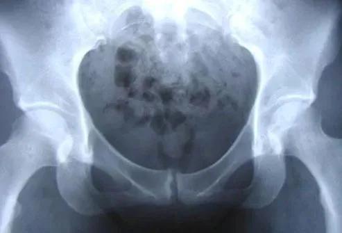 Osteitis pubis is a condition that causes chronic pelvic pain due to inflammation of joints in the pelvis and surrounding muscles.