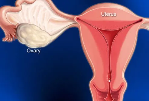 Primary menstrual cramps is pelvic pain that occurs when the uterus contracts.