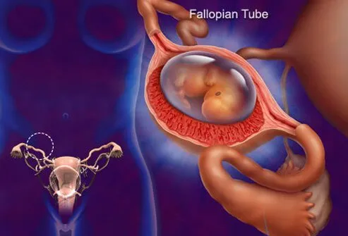 Illustration of ectopic pregnancy.