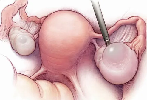 Ovarian cysts are fluid-filled areas within the ovary.