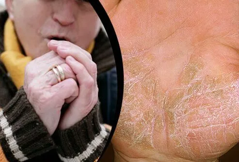 Cold weather air, dry temps, and diminished sunlight all contribute to psoriasis flares.