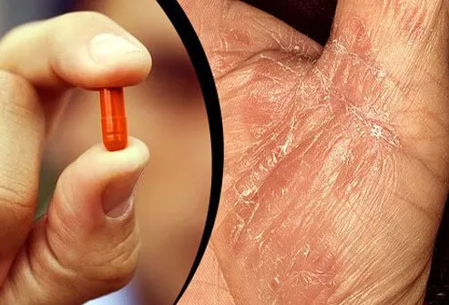 Medications may trigger psoriasis flares or make it worse.