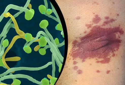 Infections activate the immune system and may trigger a flare up of psoriasis.