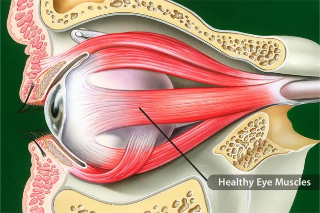 A condition called oculopharyngeal muscular dystrophy may lead to droopy eyelids. 