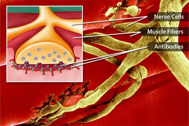 Droopy eyelids may be a symptom of myasthenia gravis. 