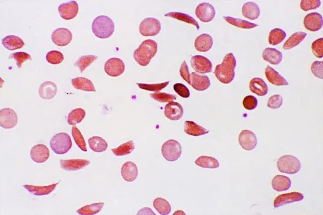 Normal red blood cells look like doughnuts and are flexible.