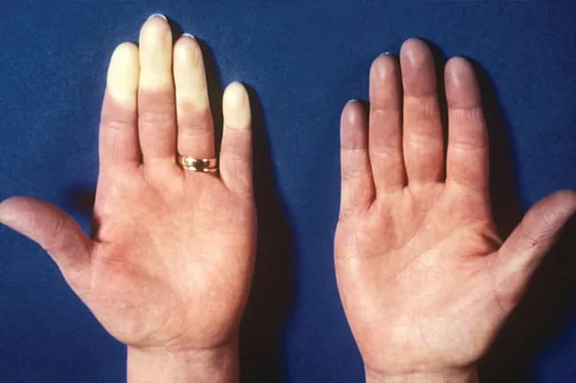 Raynaud's Disease is a rare problem that affects blood vessels in your fingers and toes.