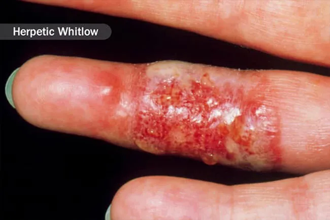 Finger infections can spread or other parts of the body if they’re not treated early.