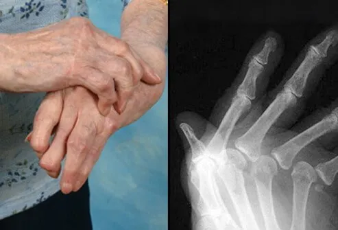 Another test used to diagnose rheumatoid arthritis is X-ray.