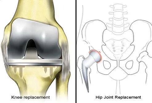 With severe rheumatoid arthritis, surgery may be needed to reduce pain and improve joint function.