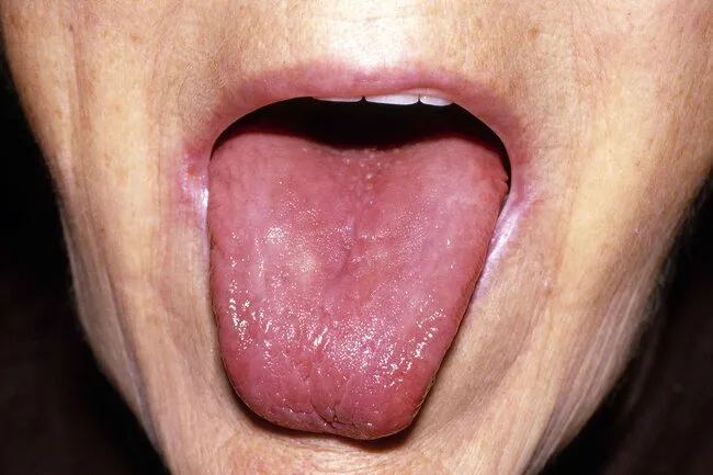 This condition is also called glossitis, for the smooth, glossy look your tongue has when it is swollen.