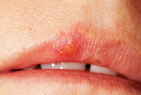 Type 1 herpes virus is more likely to develop on the face, particularly around your lips.