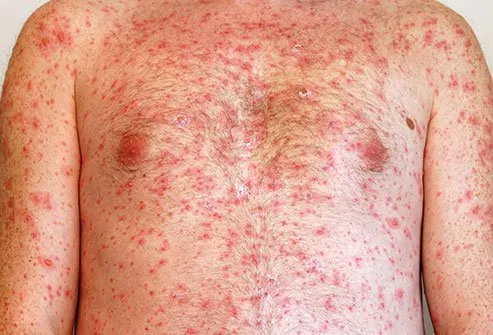 The itchy chicken pox rash begins as red bumps and spots that form into blisters full of clear fluid.