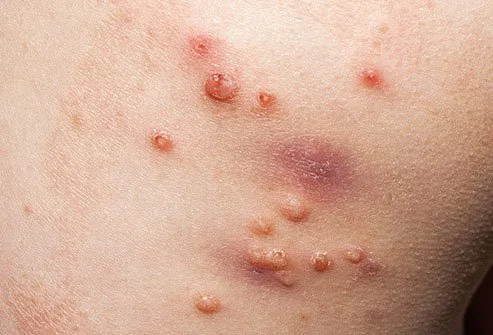 Molluscum contagiosum causes itchy, painful sores. 