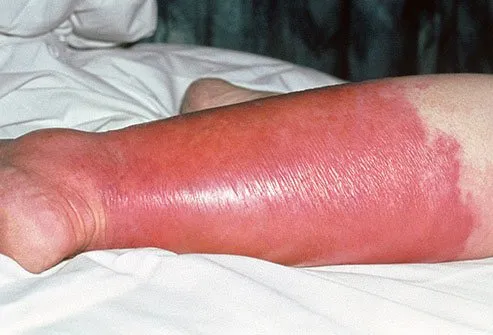 Caused by a bacterial infection, cellulitis triggers skin redness, swelling, and tenderness.