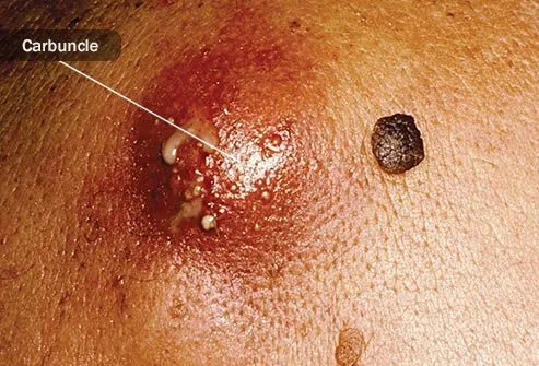 Like folliculitis, a boil develops from an irritated hair follicle.