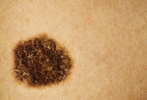 Skin cancers are growths that come in different colors, sizes, and shapes and are primarily caused by excess sun exposure. 