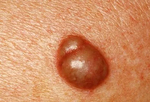 Cysts are common lumps below the epidermis that can be filled with pus, air, fluid, or other material.