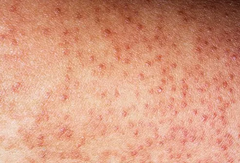 Keratosis pilaris are tiny, rough bumps made up of dead skin cells that tend to mostly appear on the buttocks and front thighs. 