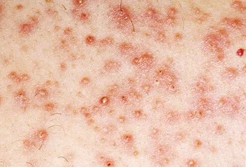 Folliculitis resembles acne pimples or crusty sores and results when hair follicles become infected and inflamed.