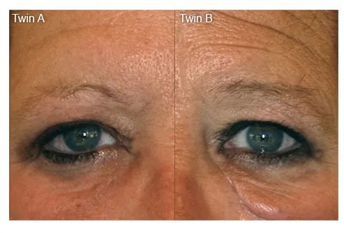 One of the characteristic signs is the looseness of the undereye skin, making her appear years older than her twin sister. 