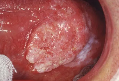 Oral cancer risk is also elevated in people who smoke or use smokeless tobacco.