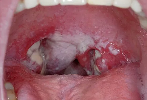 Some of the signs of strep throat will be visible.