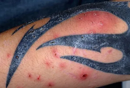 Photo of MRSA infected tattoo.