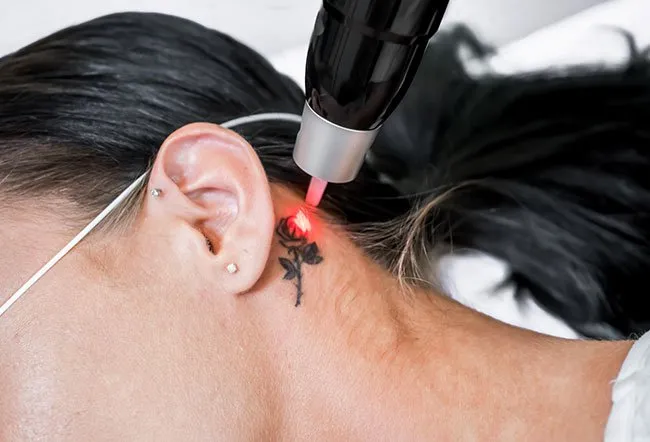 Tattoo removal therapy.