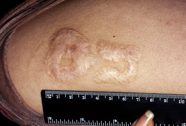 Raised scar after tattoo removal.