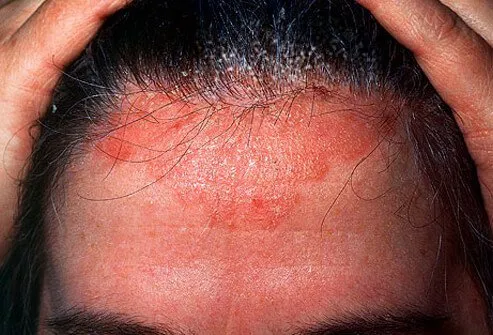 Seborrheic dermatitis can be confused with contact dermatitis, atopic dermatitis, and psoriasis.