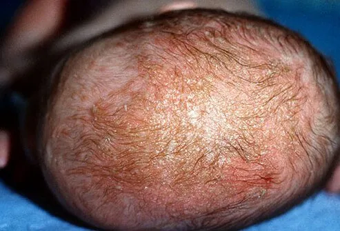 Seborrheic dermatitis in infants is called cradle cap.