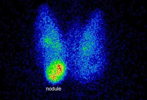 Thyroid nodules are lumps that are found inside the thyroid.