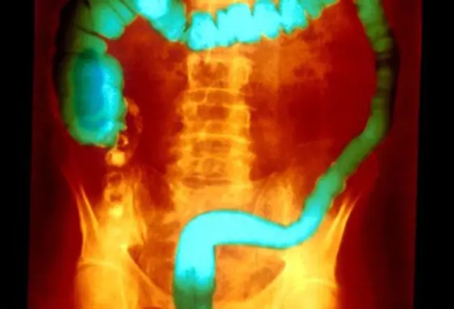 Ulcerative colitis is a disease in which there is chronic inflammation of the inner lining of the colon.