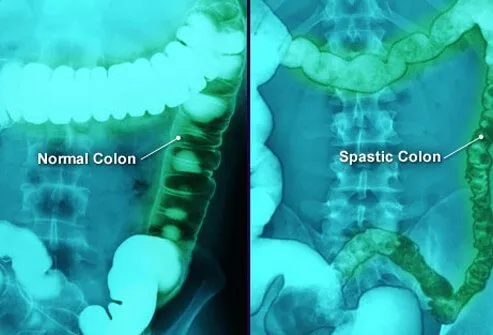 The exact cause of IBS is not known. It is believed to be caused by abnormal activity of the muscles of the intestines and/or the nerves that control the muscles.