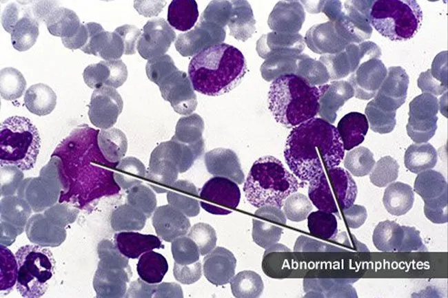 This is where it starts, with these white blood cells. Lymphocytes called B cells point out germs, and T cells destroy them.