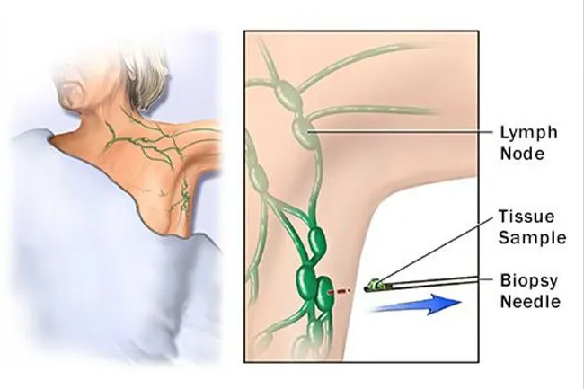 This test tells you for sure if you have cancer. Your doctor removes a swollen lymph node, or part of one, for testing.