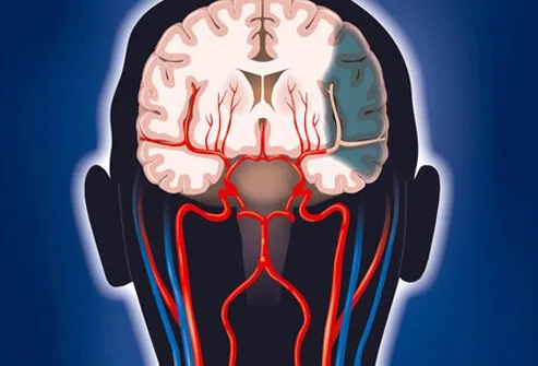 For many patients, the time limit to diagnose and treat such a clot is usually within 3 hours (some physicians suggest a bit longer). In some qualified patients, the use of a clot-busting drug may be used to dissolve the clot and restore blood flow. Not all patients qualify for this treatment. There are also some risks like bleeding associated with this treatment that may cause problems.