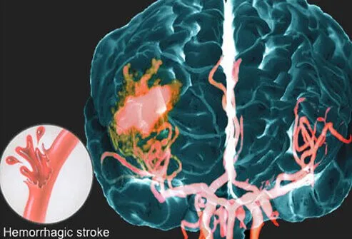 This picture shows a hemorrhagic stroke using an MRI image.