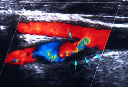 An ultrasound showing mini-stroke (TIA).