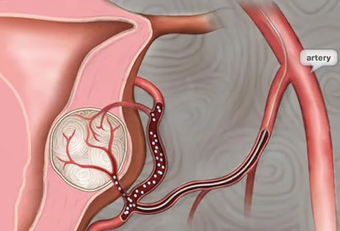 Embolization is a nonsurgical procedure that deprives the fibroids of blood, causing them to shrink. To perform an embolization, a doctor will make a small incision into the groin area in order to place a thin tube (catheter) into a large blood vessel.