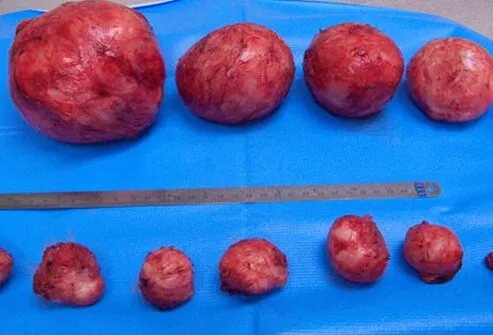 The cause of uterine fibroids is still unknown.